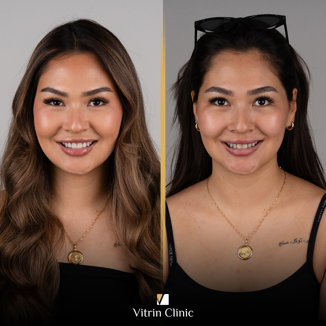 What Is Dental Occlusion? Types, Bite Problems, Assessment, and Treatment
